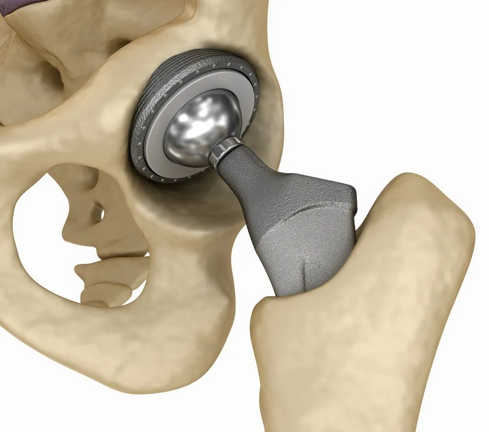 JOINT REPLACEMENT OYSTER THERAPY