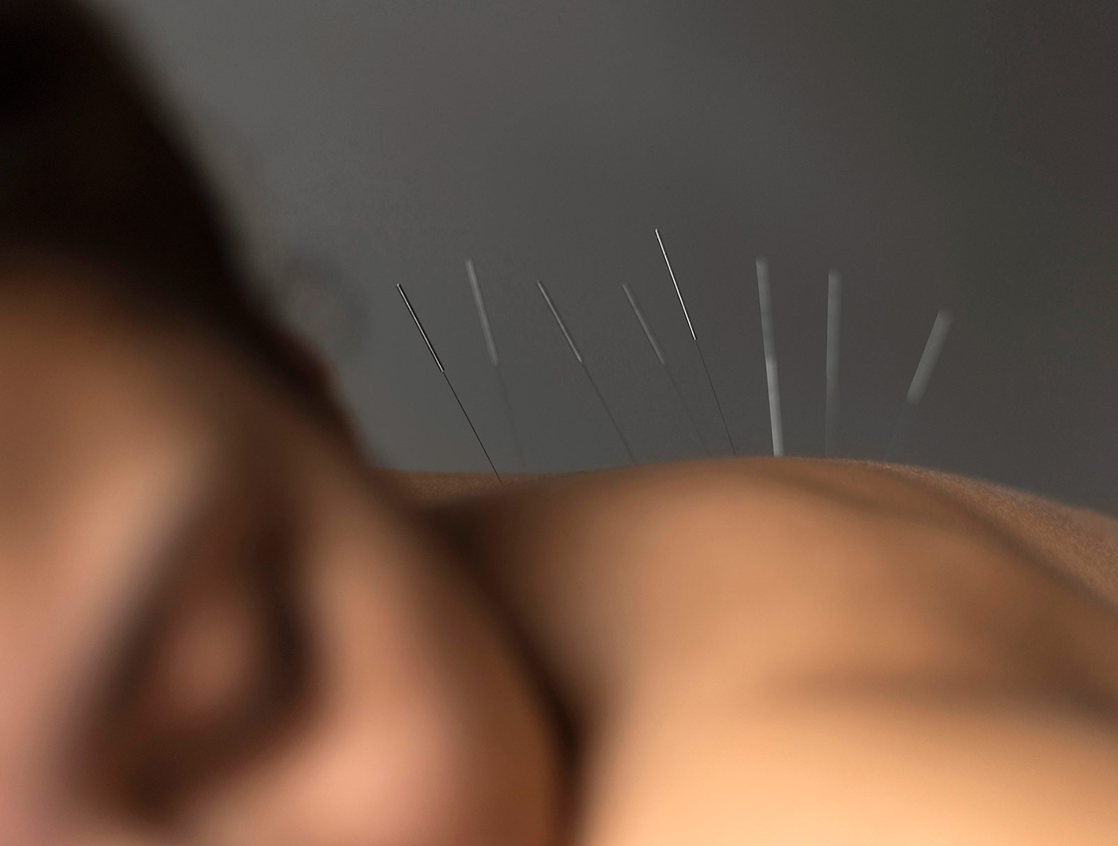 Woman receiving acupuncture on the back, zoomed in