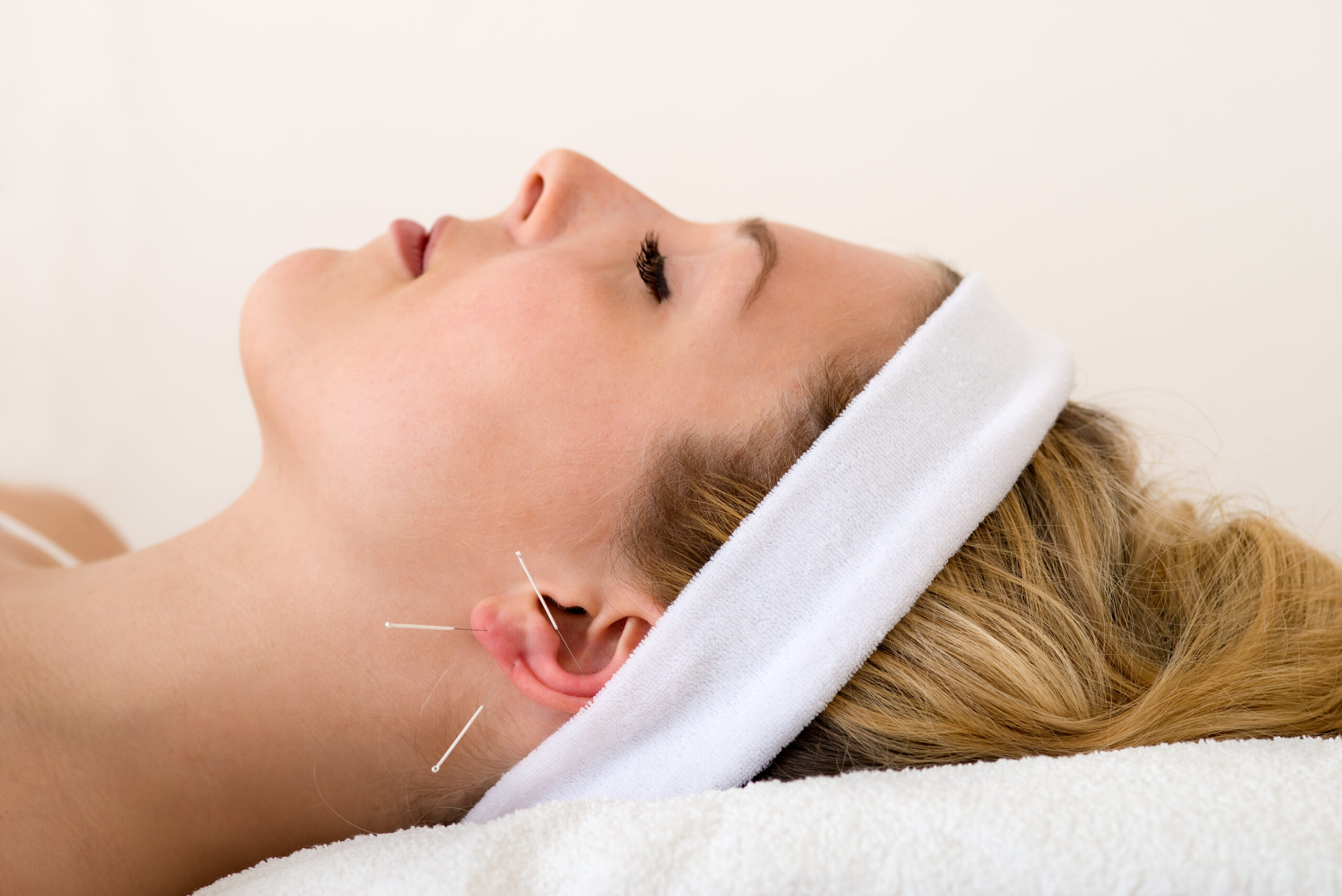 Blonde woman laying down with a acupuncture needles on her ear